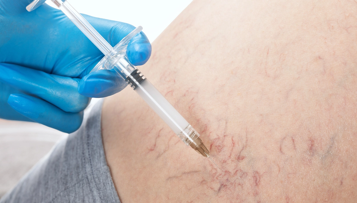 KÖPÜKLE VARİS TEDAVİSİ