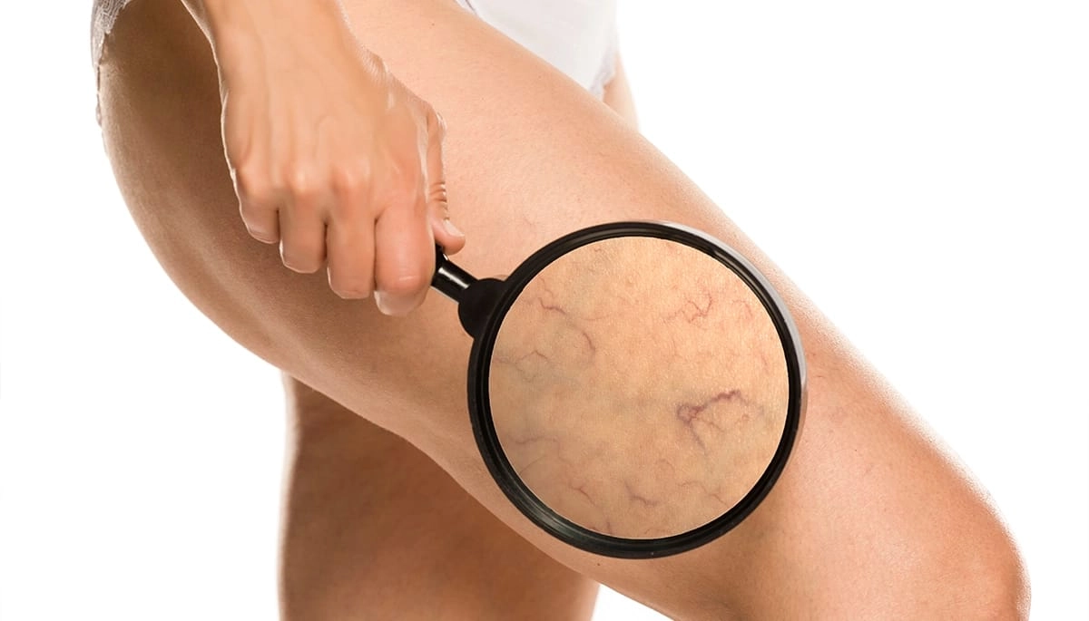 Varis Hastalığında Pıhtı Riski