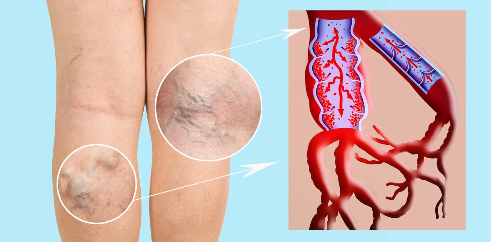 Yapıştırma İle Varis Tedavisi